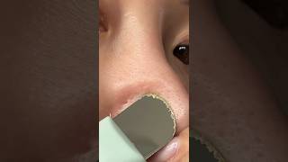 BEST BLACKHEAD REMOVER TOOL [upl. by Anez]