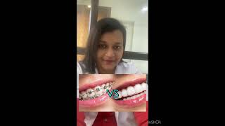 Braces or Aligners How to choose [upl. by Greenquist]