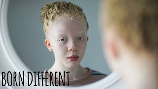 I’m Black Even With Albinism  BORN DIFFERENT [upl. by Pathe857]