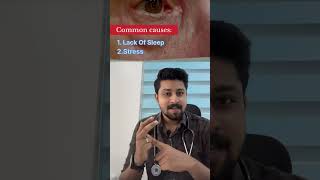 കൺപോള തുടിക്കൽ Kanpola Thudikkalmyokymia or eyelid twitchmalayalam kerala eyes eyelid health [upl. by Ahsirpac]