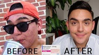 My Acne Journey ROACCUTANE [upl. by Uni]