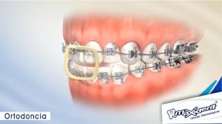 Corrección de mordida y espacios dentales quotOrtodonciaquot [upl. by Lesak79]