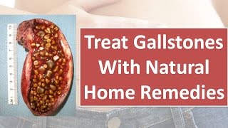 How to Treat Gallbladder Stones with Natural Remedies  Cure gallbladder stone [upl. by Annhoj798]