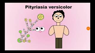 2 Pityriasis versicolor السعفة المبرقشة Malassezia furfur [upl. by Fachini387]