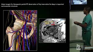 Genicular Acetabular amp SI Joint Denervation Procedures  Ramana Naidu MD [upl. by Odnala]