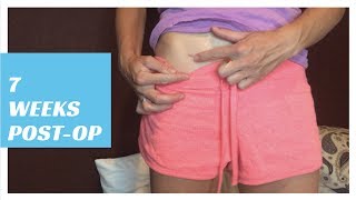 7 Week Post Op Update  Bladder Sling Bladder Lift Ovarian Tumor Cyst Removal amp More [upl. by Eedeed]