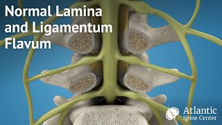 Normal Lamina and Ligamentum Flavum [upl. by Gabriella635]