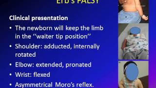 Obstetric Brachial Plexus Palsy OBPP Erbs Palsy [upl. by Derfla]