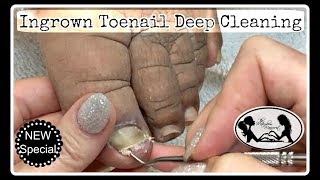 Pedicure at Home Deep Toe Nails Cleaning to Insure Ingrown Toenail Relief [upl. by Theodore]