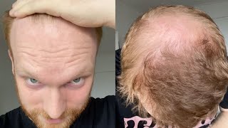 Going Bald In My Early 20s  How I Accepted Balding [upl. by Miculek]