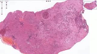 Metastasis of Pancreatic Adenocarcinoma to the Liver  Histopathology [upl. by Kristin]