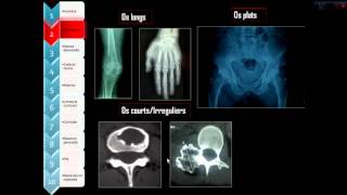 Approche diagnostique radiographique des tumeurs osseuses [upl. by Howard332]