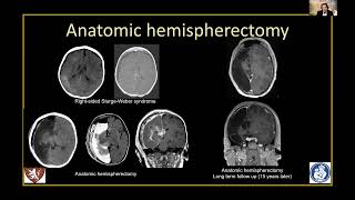 Imaging of hemispheric disconections S Prabhu [upl. by Ellirehs]