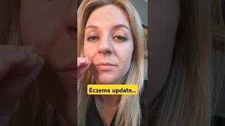 Eczema update3 days after flare up on my face manifested [upl. by Ittak]