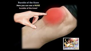 Knee Bursitis  Everything You Need To Know  Dr Nabil Ebraheim [upl. by Salchunas]