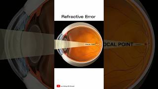 What is Refractive Error 👀  shorts [upl. by Naryb]