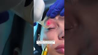 Co2 Laser Skin Resurfacing for Eyelids  Skin Tightening [upl. by Roxy407]