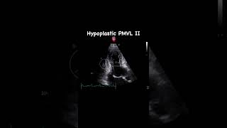 Hypoplastic posterior mitral valve leaflet  APLAX [upl. by Anallise]