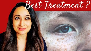 Full Guide to Freckles Treatment At Home Lasers Lightening creams DIYs for Removing Freckles [upl. by Laural866]