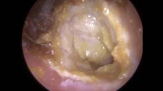 194 Eardrum about to EXPLODE after Blocked Ear Wax Removal using Endoscopic Ear Microsuction [upl. by Ojeillib]