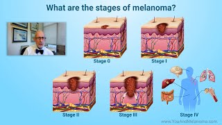 What are the stages of melanoma [upl. by Panchito9]