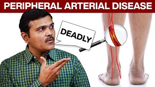 Peripheral Arterial Disease Expert Shares Lifesaving Tips You Need Now Hindi [upl. by Marrilee]