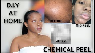 BEST AT HOME 20 GLYCOLIC ACID CHEMICAL PEEL FOR DARK SKIN  W BEFORE AND AFTER PICS [upl. by Man]