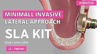 SLA Kit  Sinus Lateral Approach Kit [upl. by Llerod375]