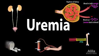 Uremia Pathophysiology Symptoms Diagnosis and Treatment Animation [upl. by Drusilla573]