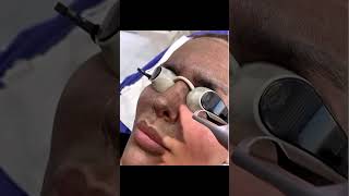 Carbon peel laser for glowing skin dermatology carbonlaserpeel viralvideo explorepage [upl. by Suirada]