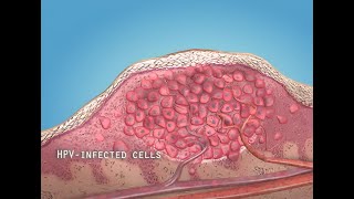 What are warts HPV  3D animation [upl. by Ilujna]