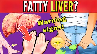 8 SIGNS THAT INDICATE LIVER FAT  EARLY SYMPTOMS OF HEPATIC STEATOSIS silent threat [upl. by Wagner]