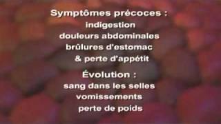 Cancer de l estomac Symptômes Définition Diagnostic Traitements [upl. by Leveroni]