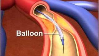 Percutaneous coronary Intervention stenting [upl. by Knuth]