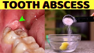 How to get rid of a tooth abscess without going to the dentist  Gum abscess treatment [upl. by Nynnahs]