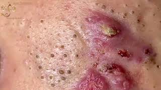 Blackheads Extraction Whiteheads Removal Pimple Popping 1 [upl. by Gnas255]