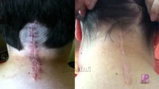 Chiari Malformation 1 Year PostOp [upl. by Ainekahs]