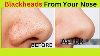 Do THIS to Remove Blackheads From Your Nose today [upl. by Nidraj]