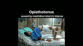 Opisthotonus caused by clostridium tetani in tetanusdoctorviral viralvideo ankylosingspondylitis [upl. by Ellekim]