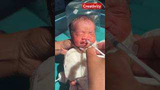 Cleft lip baby feeding medical baby trendingshorts viral [upl. by Itsa]