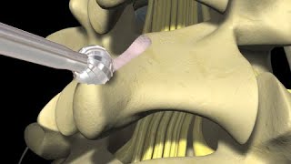 Low Back Pain Lumbar Laminectomy Surgery [upl. by Mannos]