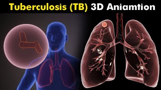 What Happens in Tuberculosis TB  3D Animation  Types Causes Symptoms Treatment UrduHindi [upl. by Anieral71]