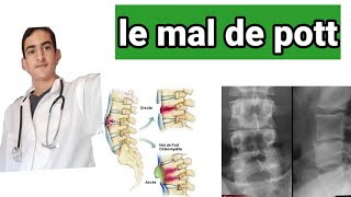 le mal de pott ou spondylodiscite tuberculeuse [upl. by Urina646]