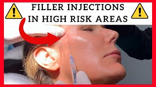 Filler Injections in High Risk Areas Temples Forehead Tear Trough Preauricular and Jawline [upl. by Allyson]