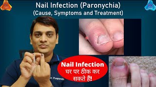 Nail Infection Paronychia  Cause amp Treatment  नाखून संक्रमण का इलाज कैसे करें Dr Puspendra [upl. by Ludovico]