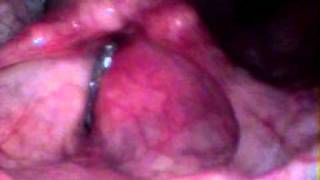 Endoscopia de Laringe  Vídeo 2 [upl. by Martha]