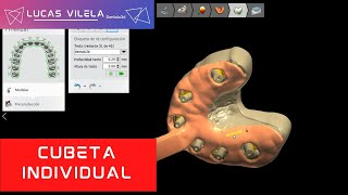 CUBETA INDIVIDUAL IMPLANTES  3SHAPE [upl. by Edalb]