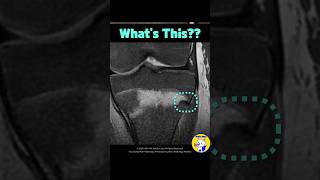 Fig 4B25 Ogden Type IV Tibial Tuberosity Fracture [upl. by Lehet]