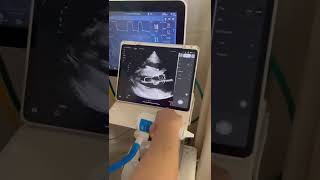 Portable Handheld Wireless Cardiac Ultrasound portableultrasound [upl. by Htes361]