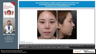 Use of Autologous AdiposeDerived Stromal Vascular Fractions in Revision Rhinoplasty for Severe [upl. by Garcia]